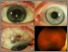 [thumbnail of Thaung_Immune privilege. Failure of immunotherapy in controlling metastatic cutaneous melanoma to the eye_Figure1.tiff]