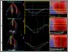 [thumbnail of Figure 1 - Cardiac Amyloidosis - Multi-modal Imaging.tif]