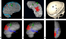 [thumbnail of JPG Fig. 6.   Use of M3N for implantation of depth electrodes in Patient 13.]